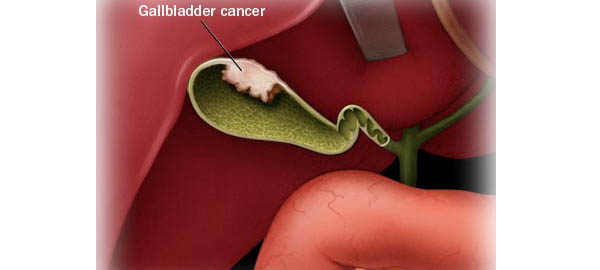 Gallbladder Cancer