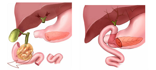 Pancreaticoduodenectomy (Whipple Procedure)
